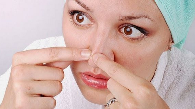 Simak Fakta Mengejutkan Ini, Bahan Skincare Dapat Memicu Munculnya Komedo