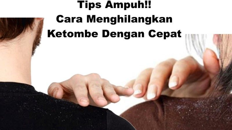 Apa Sih Penyebab Ketombean? Berikut Solusi Efektif dan Cara Mengatasinya