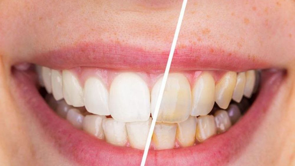 6 Tips Memutihkan Gigi Kuning Dengan Cepat Menggunakan Cara Alami 