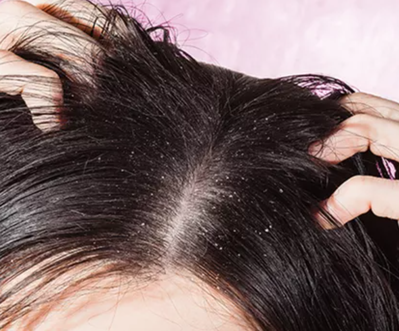 Simak Cara Mudah Mencegah Rambut Rontok dan Ketombe dengan 5 Bahan Alami Ini