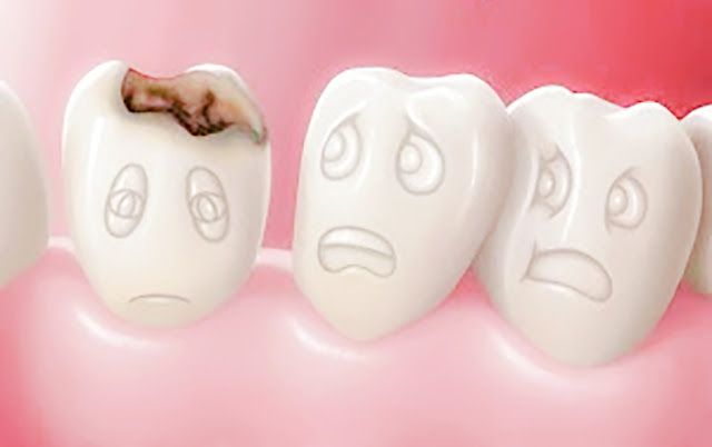 Ada Beberapa Gejala dan Penyebab Gigi Berlubang, Kalian Harus tau Bagi Orang yang Gigi nya Suka Bolong