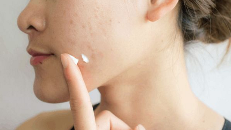 Rekomendasi Serum Wajah Paling Ampuh Menghilangkan Bekas Jerawat