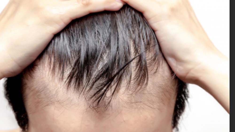 Jangan dibiarkan! Rambut Berminyak Dapat Menyebabkan Bau Tidak Sedap, Atasi Segera! Ini 7 Caranya