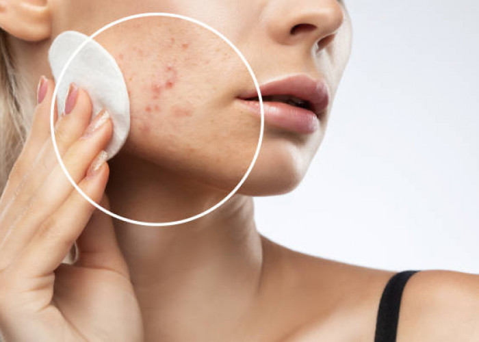 Tips Menghilangkan Jerawat dalam 3 Hari dengan Skincare, Begini Urutan Penggunaannya!