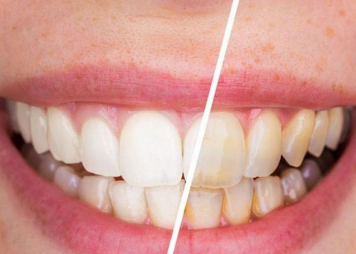 6 Tips Memutihkan Gigi Kuning Dengan Cepat Menggunakan Cara Alami 