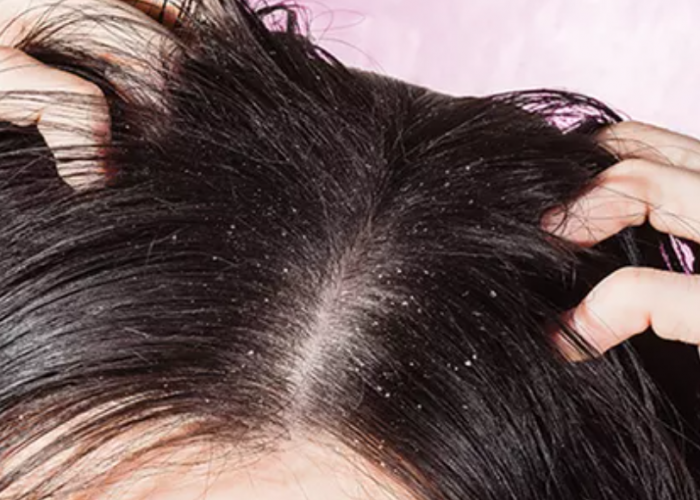 Simak Cara Mudah Mencegah Rambut Rontok dan Ketombe dengan 5 Bahan Alami Ini