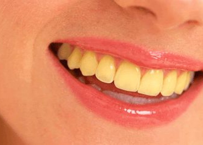8 Penyebab Gigi Kita Ini Menjadi Kuning, Nomor 4 Banyak Banget yang di Alami Oleh Laki-laki