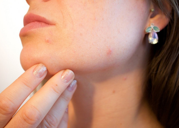 Skincare Alami: Cara Efektif Memutihkan Kulit dan Menghilangkan Bekas Jerawat, Biar Makin Glowing!