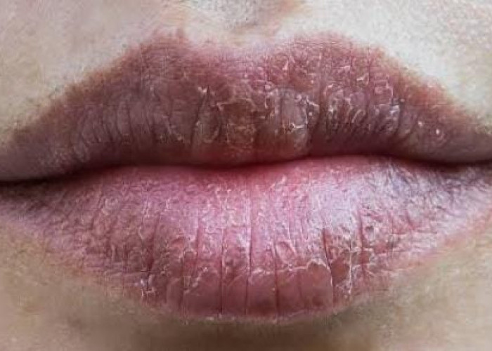 Bibir Kalian Kering dan Pecah? Berikut 6 Cara Mengatasinya